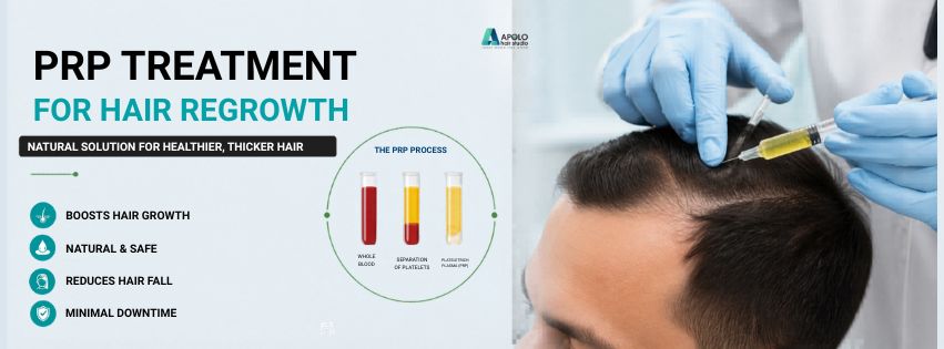 prp hair treatment in noida