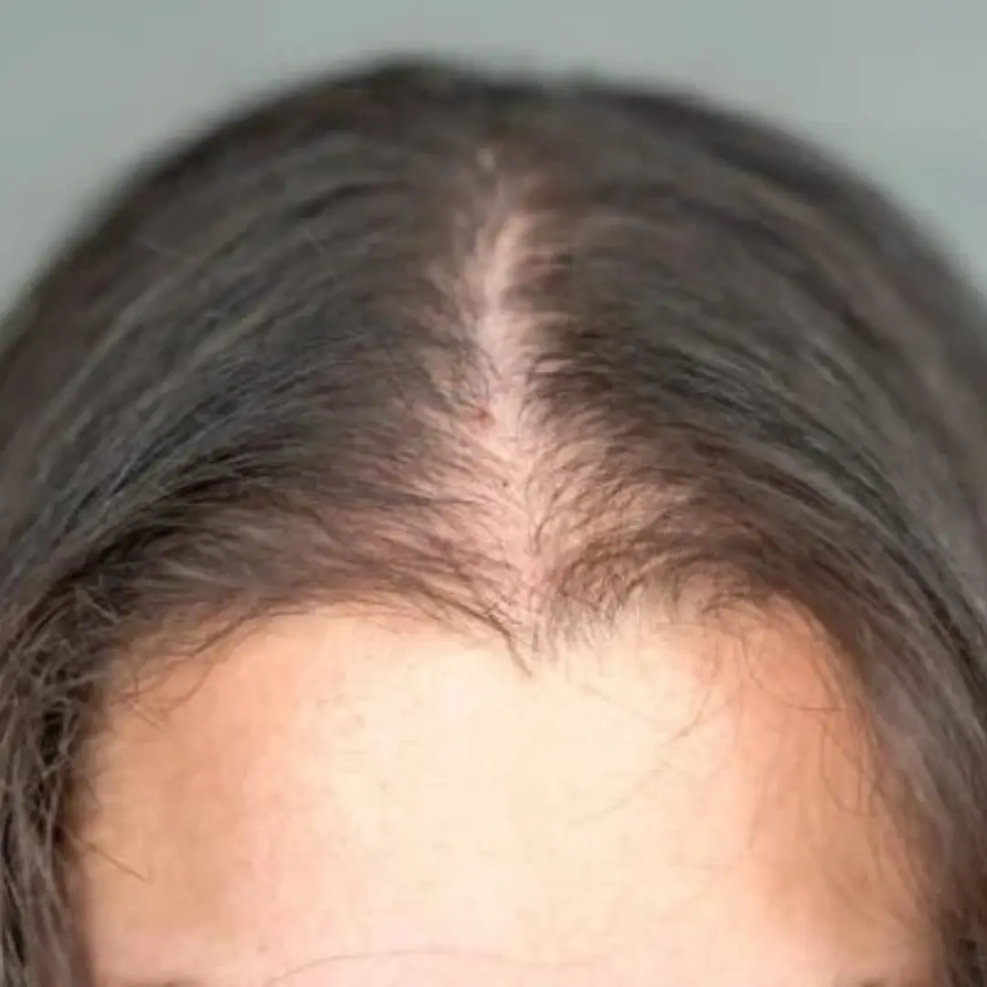 hair loss treatment in noida