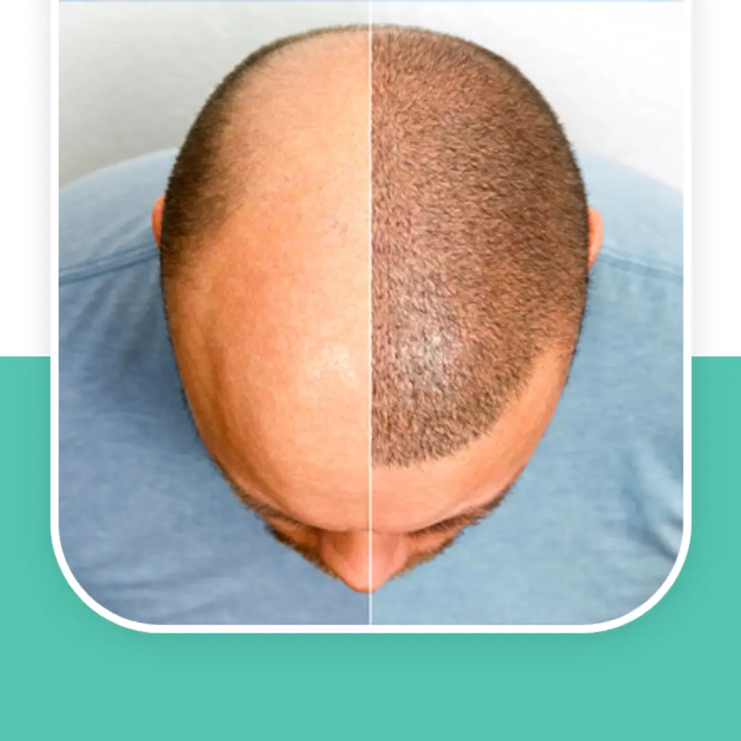 hair transplant cost in noida