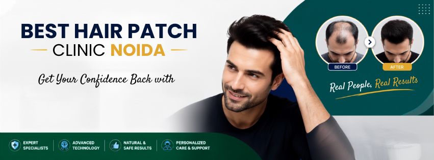 Best Hair Patch Clinic in Noida