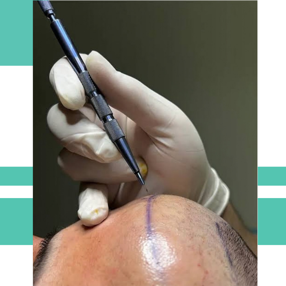 Sapphire Hair Transplant